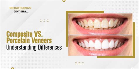 Understanding Composite Veneers in Comparison to .